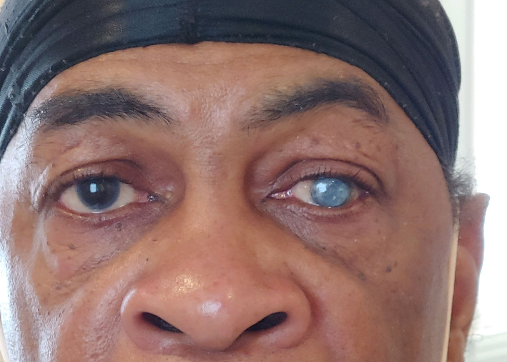 What Do Prosthetic Eyes Look Like?