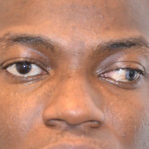 iris matching before and after - before photo