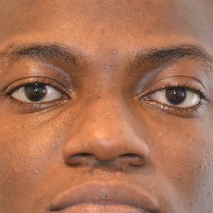 iris matching before and after - after close up photo