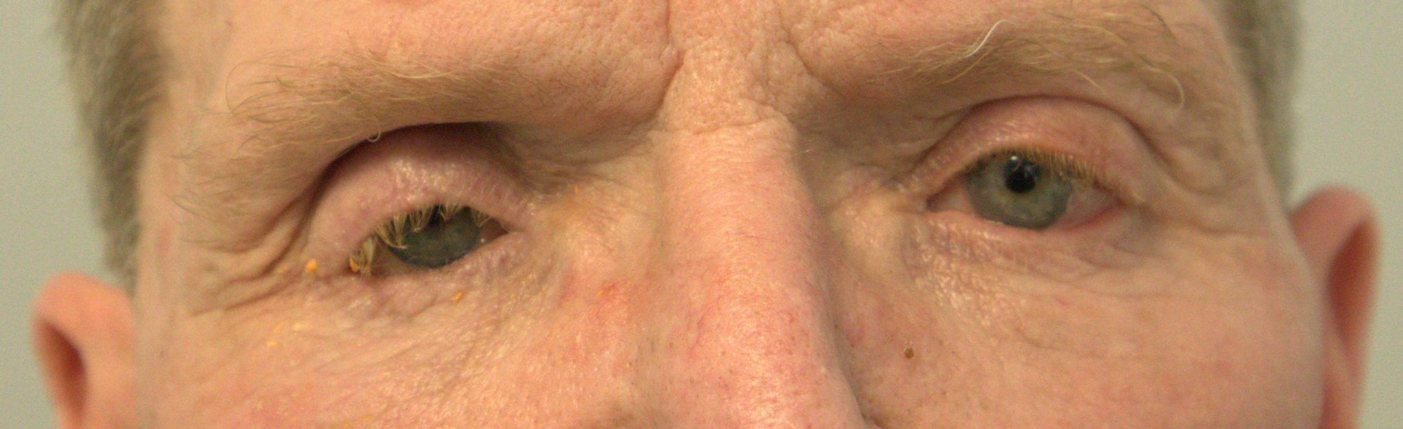 SelfCare & Prosthetic Eyes ┃ Carolina Eye Prosthetics ┃ Burlington, NC