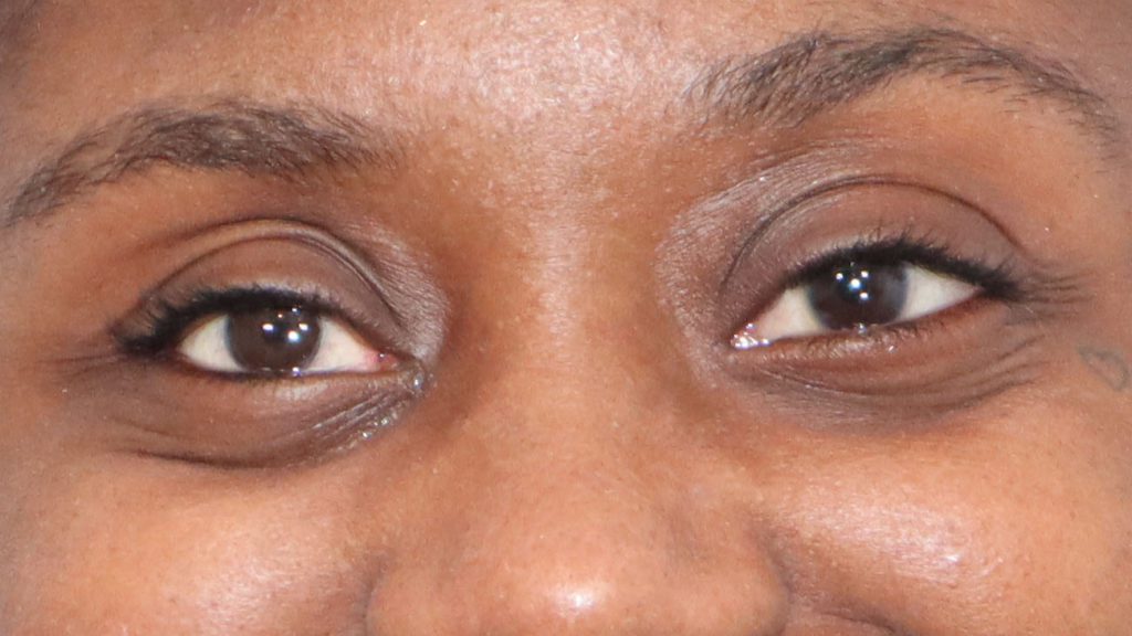 What Do Prosthetic Eyes Look Like?