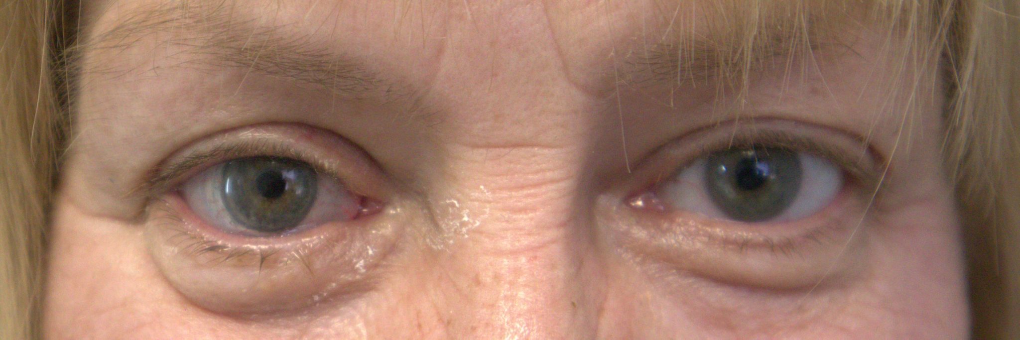 Eye Loss What Does It Look Like? Carolina Eye Prosthetics